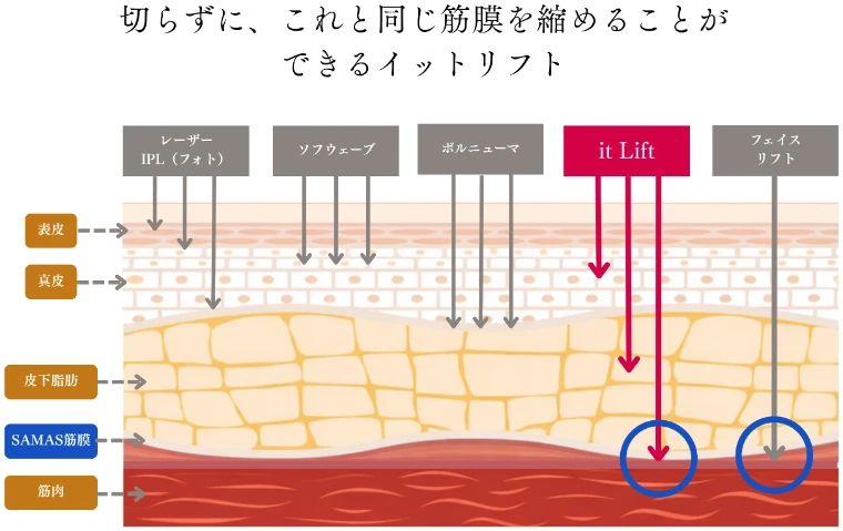 切らずに筋膜を縮められるイットリフトの到達層の図