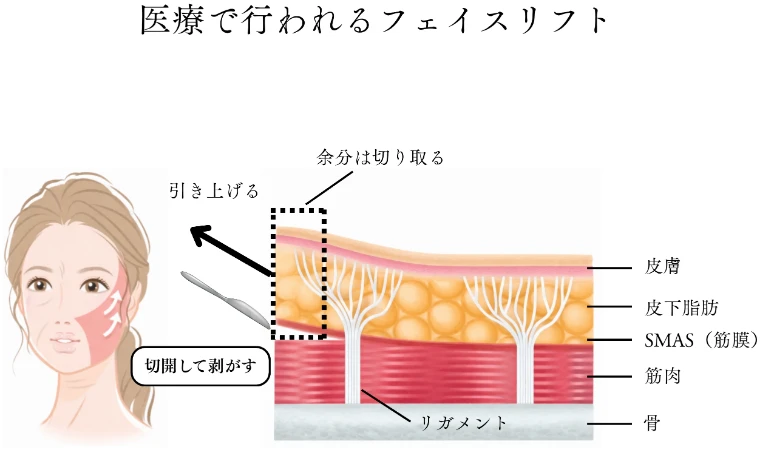 医療で行われるフェイスリフトの皮膚断面図