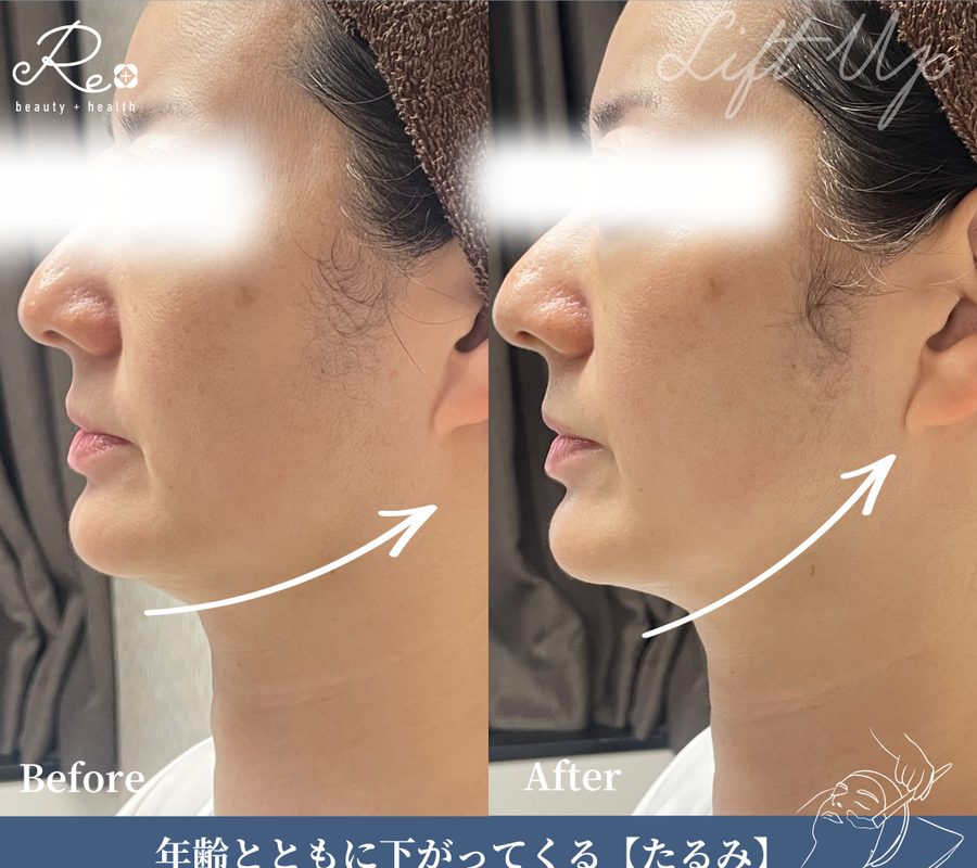 施術前と施術後のフェイスラインの比較