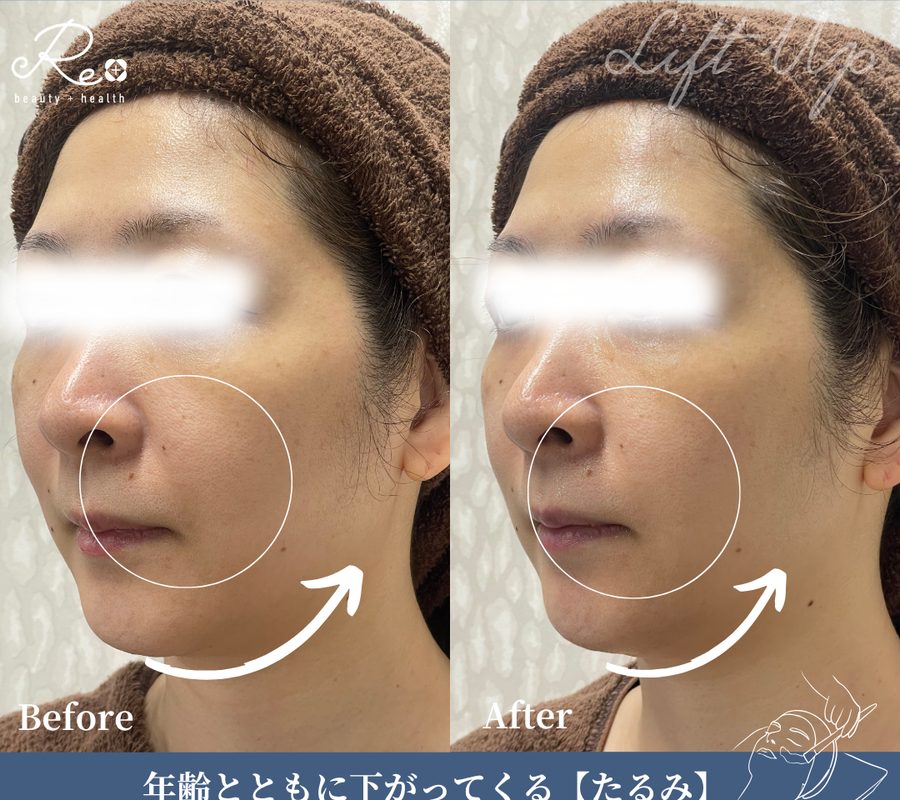 施術前と施術後のほうれい線まわりの比較