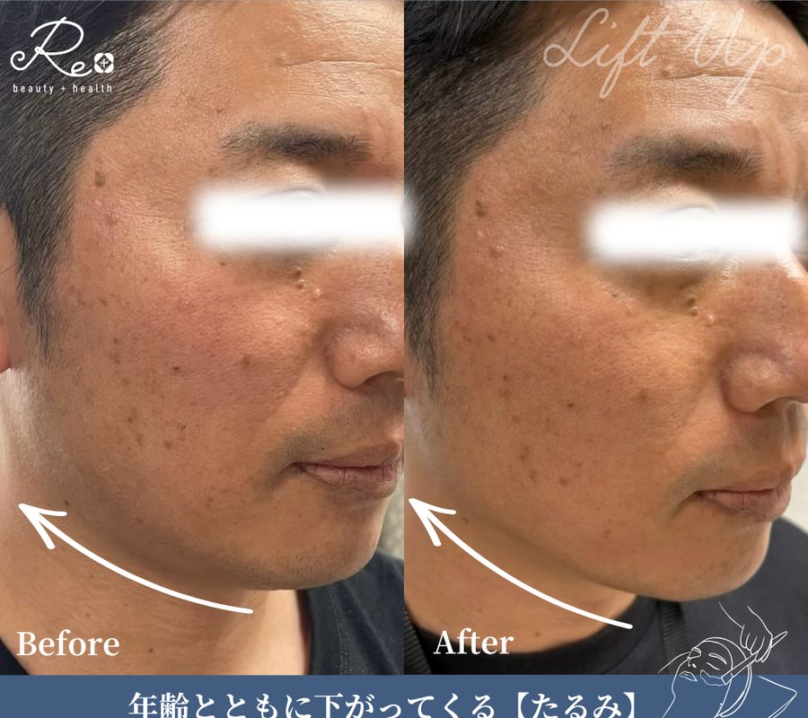 男性の施術前と施術後の比較