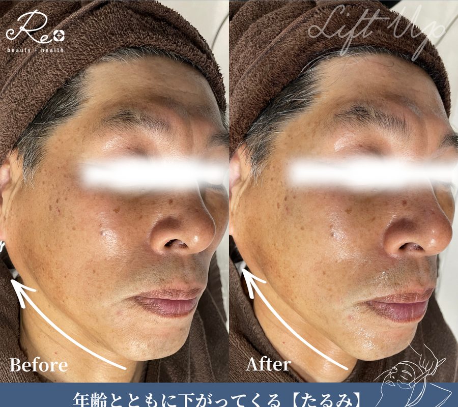 男性の施術前と施術後の頬まわりの比較