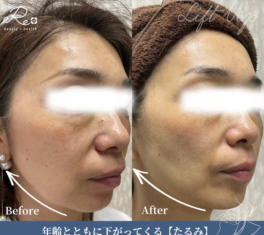 施術前と施術後の頬の比較
