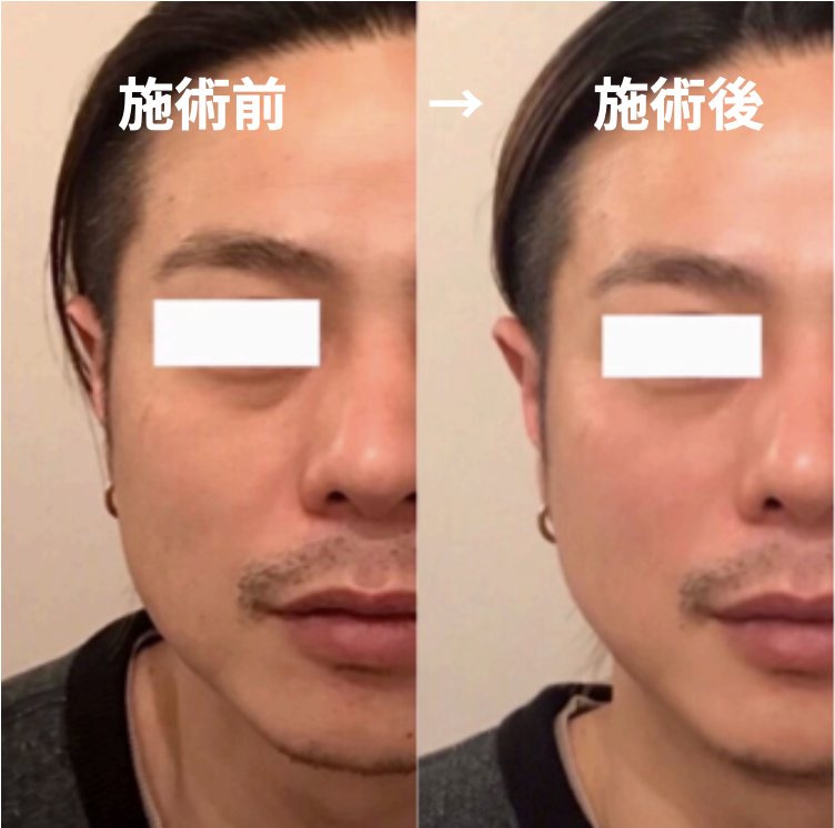 男性の施術前と施術後