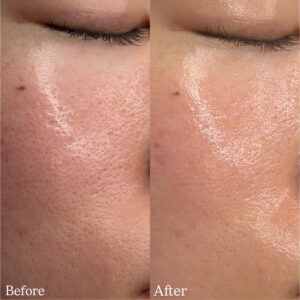 バクチオールピーリング