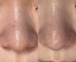 バクチオールピーリング